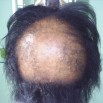 Alopecia-Cicatrizante